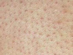 毛周角化症鸡皮肤怎么治疗最有效,鸡皮肤毛囊角质怎么去除最有效