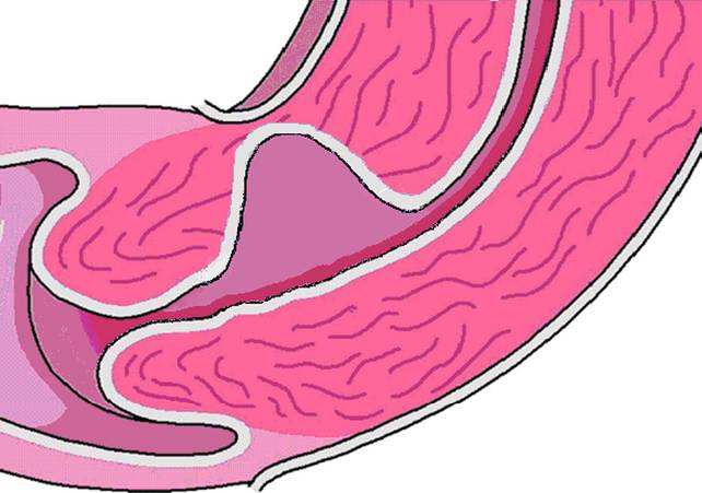 疤痕憩室手术修补多久可以怀孕,宫腹腔镜修补子宫憩室