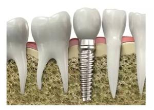 单颗门牙缺失牙桥修复,固定桥修复缺失牙