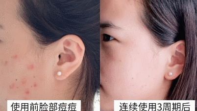 用香皂洗脸去油祛痘,硫磺香皂洗脸可以祛痘去油吗