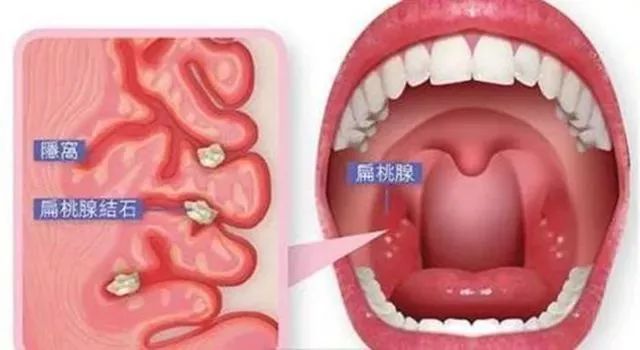 闭着嘴巴一会就干有异味,闭着嘴巴都感觉口腔有异味