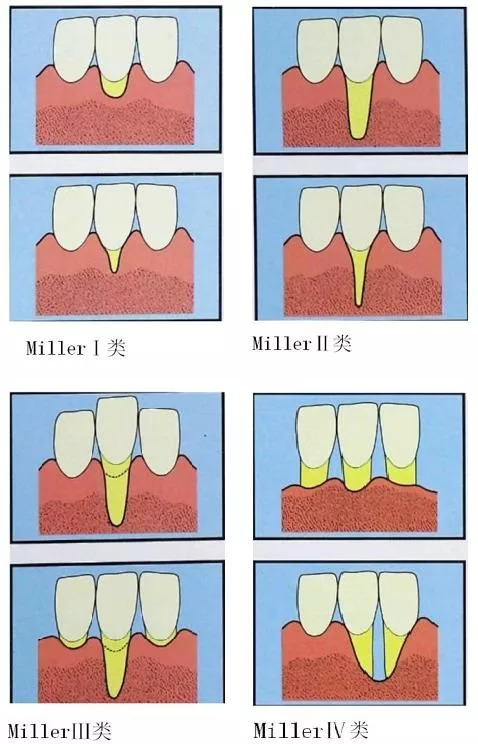 牙龈退缩怎么样刷牙,牙龈退缩牙根暴露怕冷热怎么办