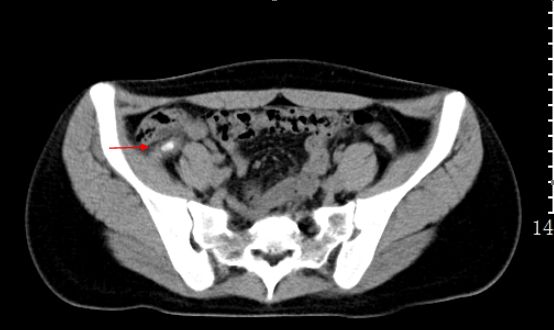 急诊科常见急腹症观察,腹部急诊影像大全值得收藏