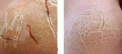 手上冻疮干裂怎么办,手脚冻脸上冻疮三天快速消除