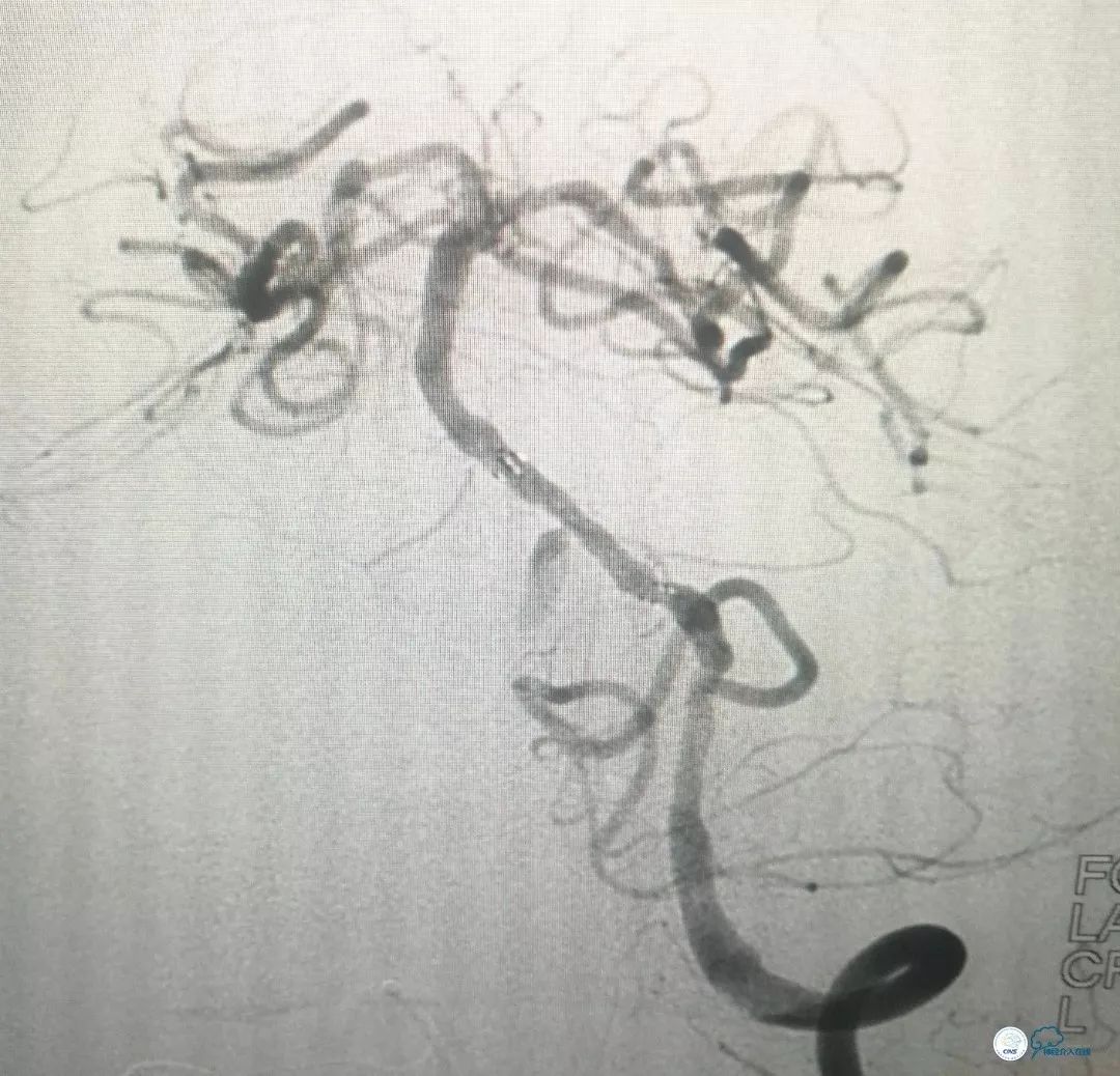 椎动脉狭窄介入手术病例汇报,基底动脉狭窄70%的介入治疗