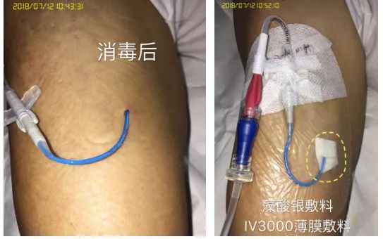 picc穿刺点有脓咋办,picc导管穿刺部位渗血