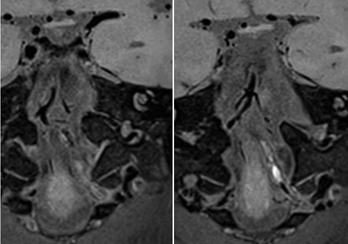 椎动脉起始段狭窄的介入治疗ppt,椎动脉v4段假性动脉瘤介入治疗