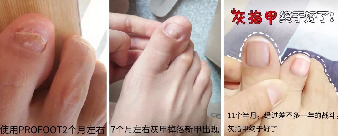 十年灰指甲可以治好吗,一次搞定顽固灰指甲