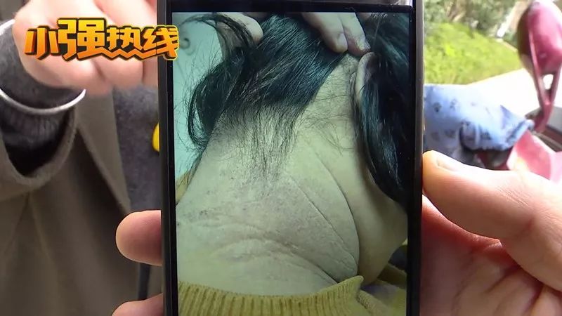 湿疹孩子成功治愈案例,女儿湿疹终于好了