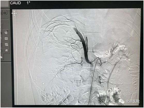 肿瘤肾癌微创手术费用,医大二院肾癌微创手术