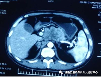 胰腺癌碘125粒子治疗术几天出院,胰腺癌晚期适合碘125粒子植入吗