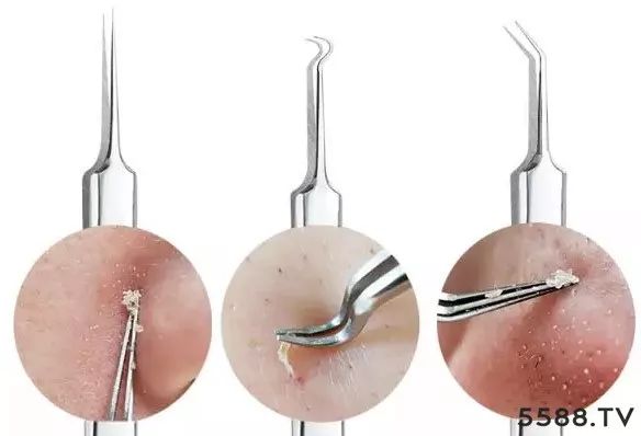 黑头去不掉的原因和解决方法,黑头去除不干净