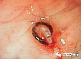 女子一周便血,大量便血真实案例