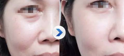 玻尿酸填充是个无底洞吗,玻尿酸是不是无底洞