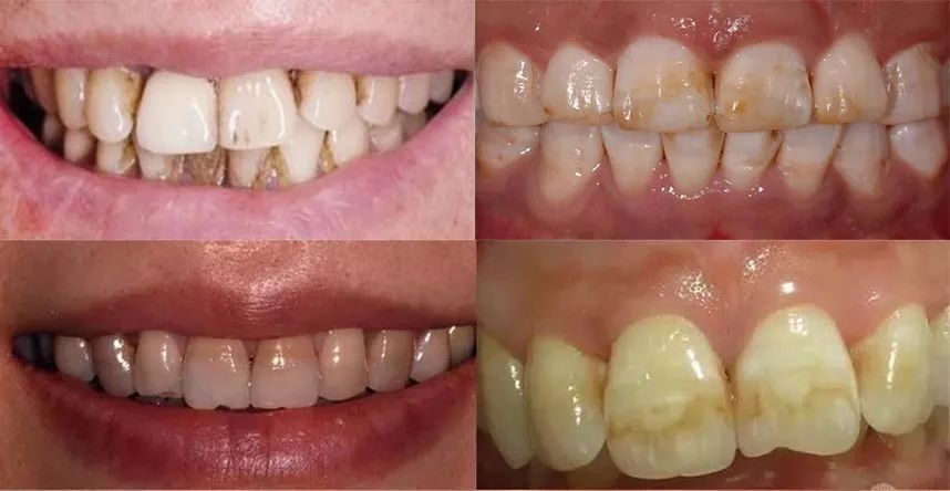 英国人被嘲几十年的黄牙口臭，终于靠它洗白了