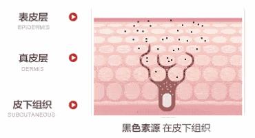 严重痘印晒斑,5个祛斑小妙招淡化晒斑雀斑痘印