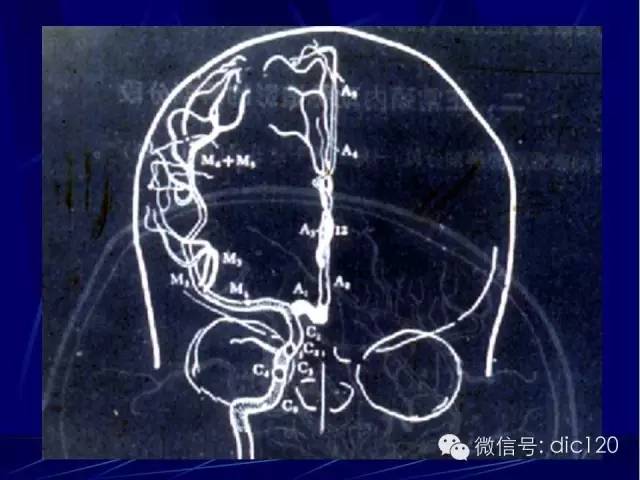 脑血管解剖技巧,脑血管解剖与介入