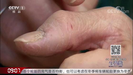 一到冬天手脚起皮干裂怎么治,冬天手脚干裂一招轻松缓解