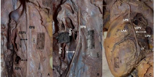 做完消融手术后胸闷憋气,射频消融术后胸闷气短是怎么回事