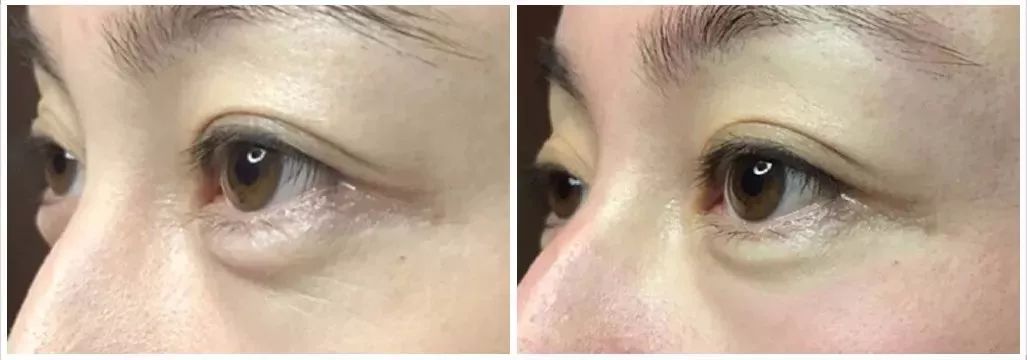 每天眼上敷一片，眼不花看得清，再也不怕近视了，男女老少都爱！