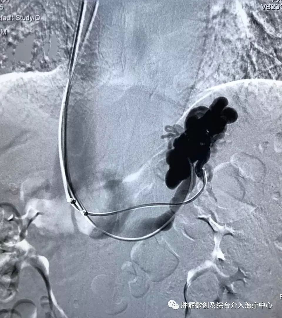 运城第一医院肿瘤介入科专家,运城市第一医院介入科专家