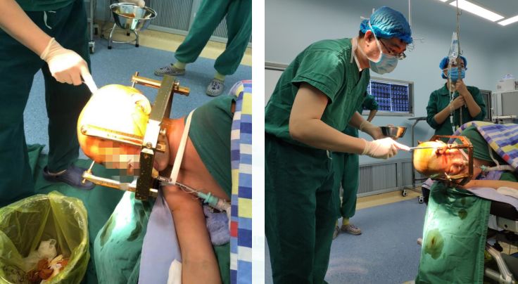 赞！重庆三博江陵医院成功开展脑干占位立体定向活检术！