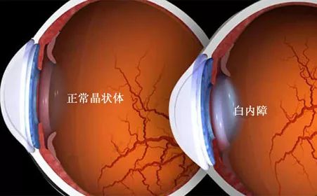 共享大医生｜得了白内障，怎么办？