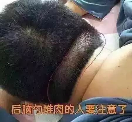 后脑勺堆肉脑梗的前兆,后脑勺脑梗纹怎么缓解