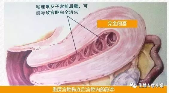 闭经如何补充雌激素,闭经如何处理