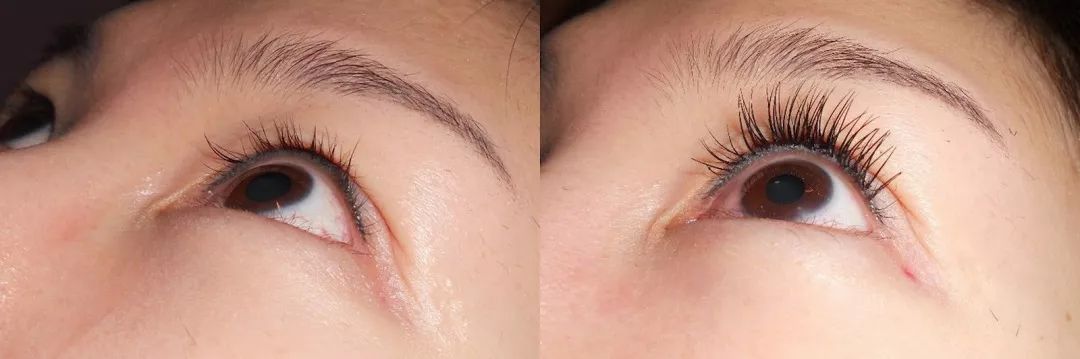 疯狂掉头发发际线后移,疯狂掉头发头发变得稀疏