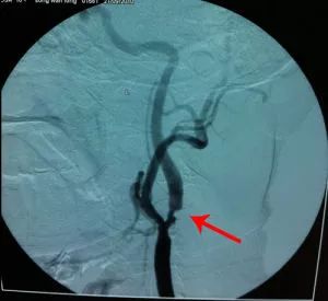 中医治疗心血管狭窄专家教授,倪海厦讲颈部血管狭窄的治疗方法