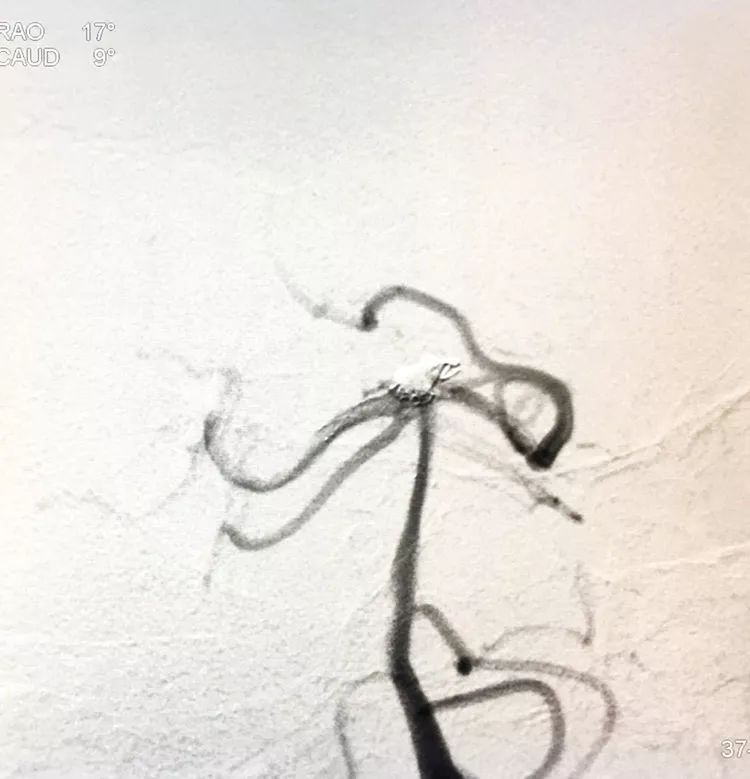 柳暗花明专栏|栓塞颅内动脉瘤时微导管无法穿过LVIS支架网眼怎么办