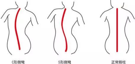 得了脊柱侧弯？你应该这样解决