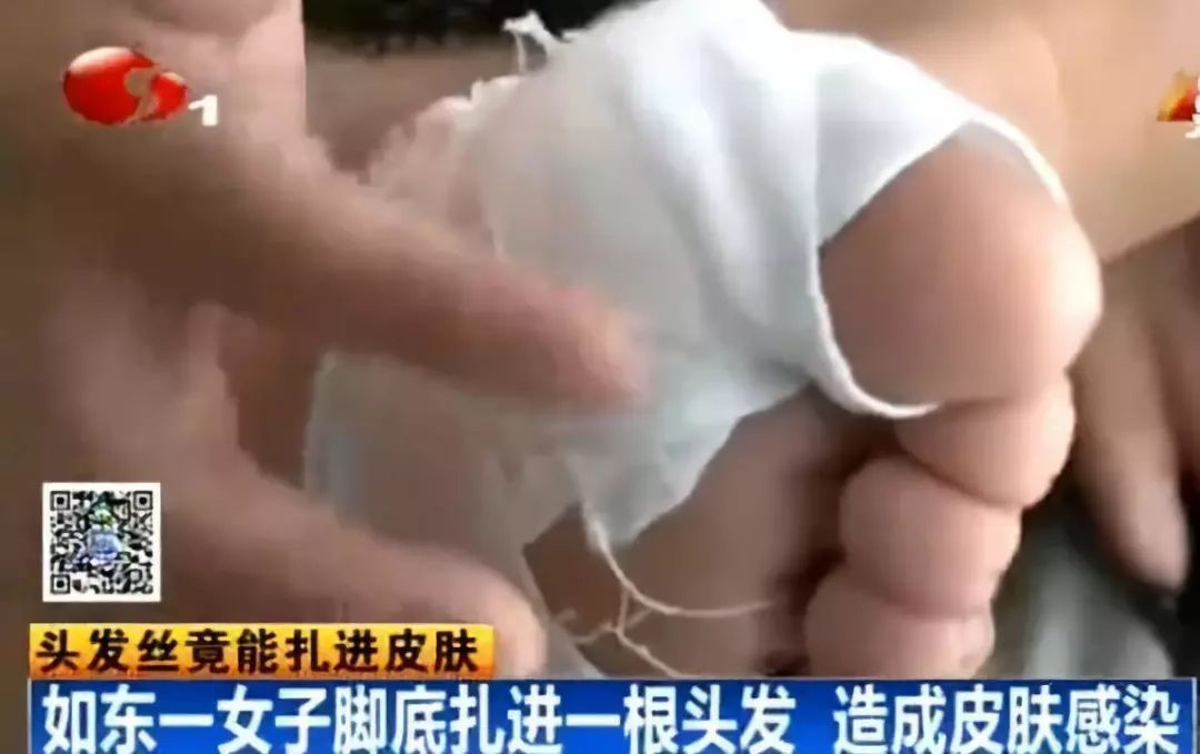 一根头发扎进皮肤里了,一根头发扎到皮肤