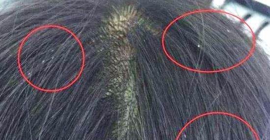 头皮屑洗不掉怎么办有什么方法,头发头皮屑多且大块还结痂有虫