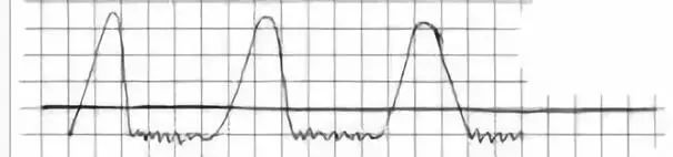 体温计最高温度为什么是42,体温计刻度只有42c正常吗