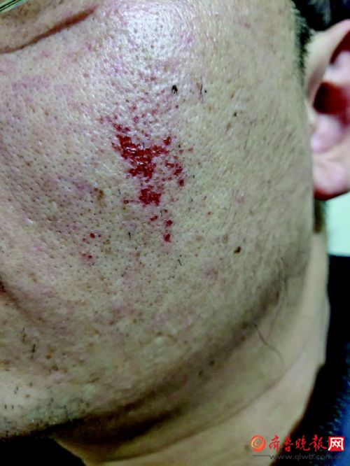 京东买的脱毛膏伤皮肤了怎么解决,淘宝买脱毛膏毁容了怎么办