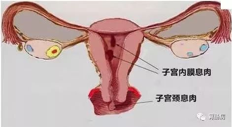 一文盘点|临床上常见的息肉病