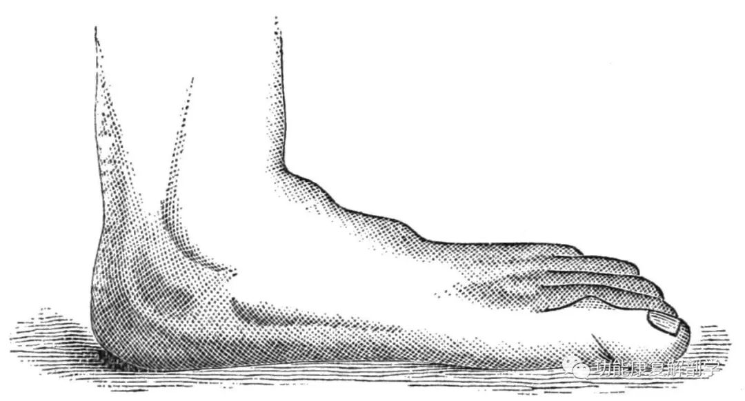 止点性跟腱炎如何治疗,中医治疗跟腱炎的方法
