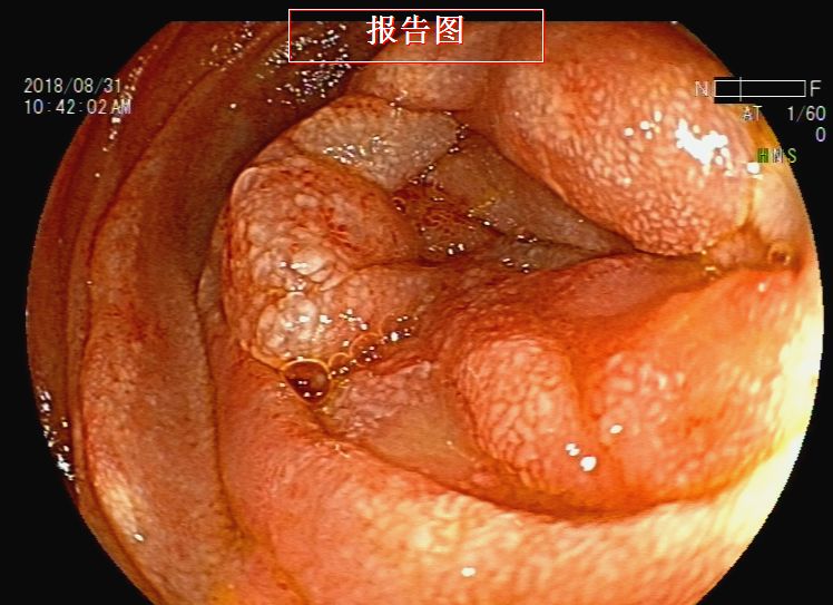 消化道支架置入术,消化道梗阻支架怎么放