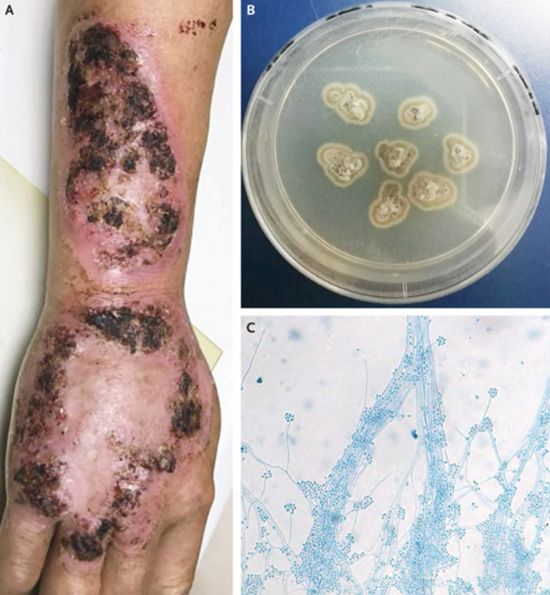 孢子丝菌病怎么治最快,孢子丝菌病传染他人吗