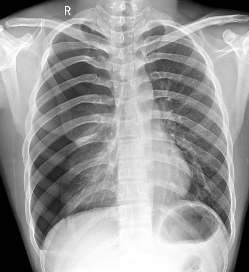 气胸的x线表现胸膜炎,胸外科气胸病人病例