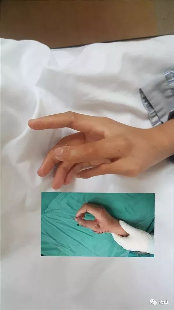 少年先天性多指感到自卑，爱心接力来金接受手术……