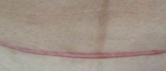 女儿摔破了头流血怎么办,女儿摔破头了我很自责