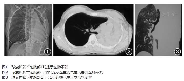 球囊扩张治疗狭窄,支气管结核冷冻术