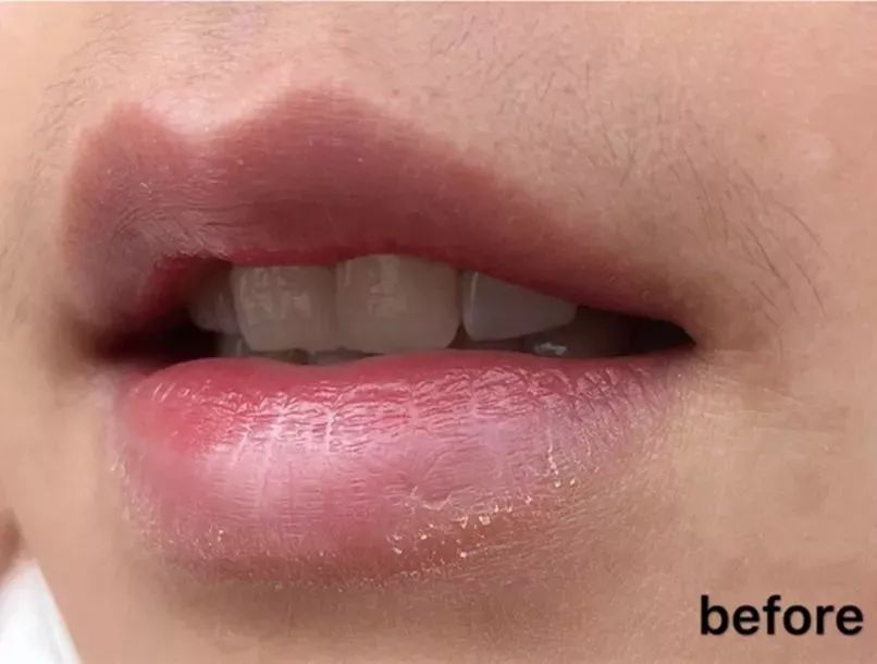 女士永久脱毛推荐排行榜第一名,美容永久脱毛抖音团购