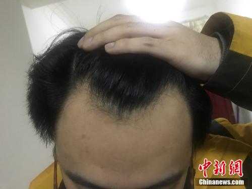 脱发青年养发生发过程分享,脱发人的自白
