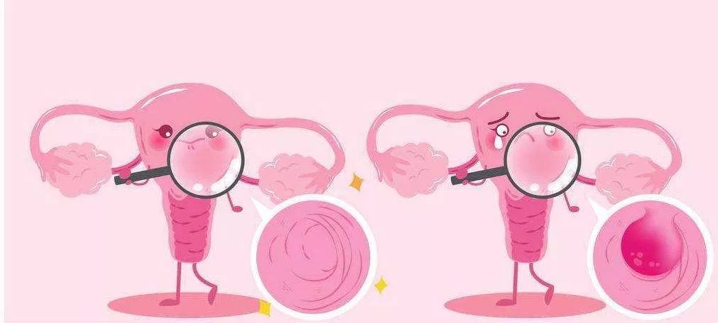 更年期内膜增厚出血一定是癌吗,绝经后出血是子宫内膜癌的前兆吗