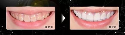 急急急！全城寻找缺牙、难看牙市民，每人最高获助20000元！