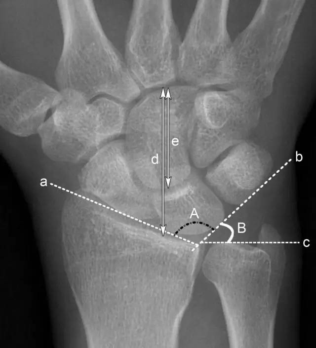 青少年尺腕关节脱位x线诊断标准,腕关节侧位x线片读片技巧